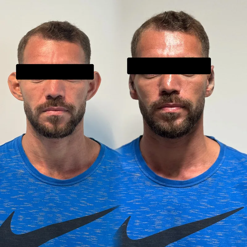 Antes y después de un tratamiento en Salinova